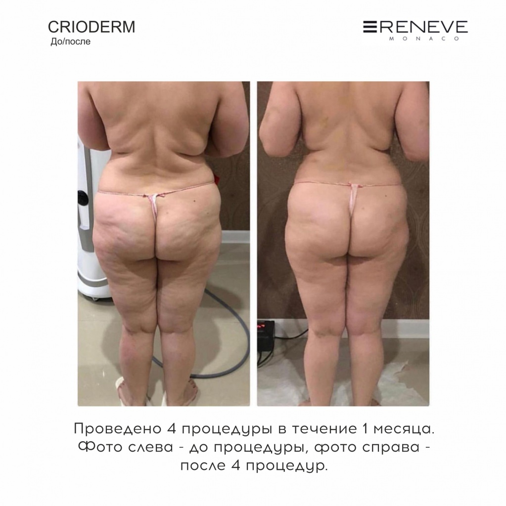 Результаты процедуры криолиполиза на аппарате Crioderm Reneve Monaco